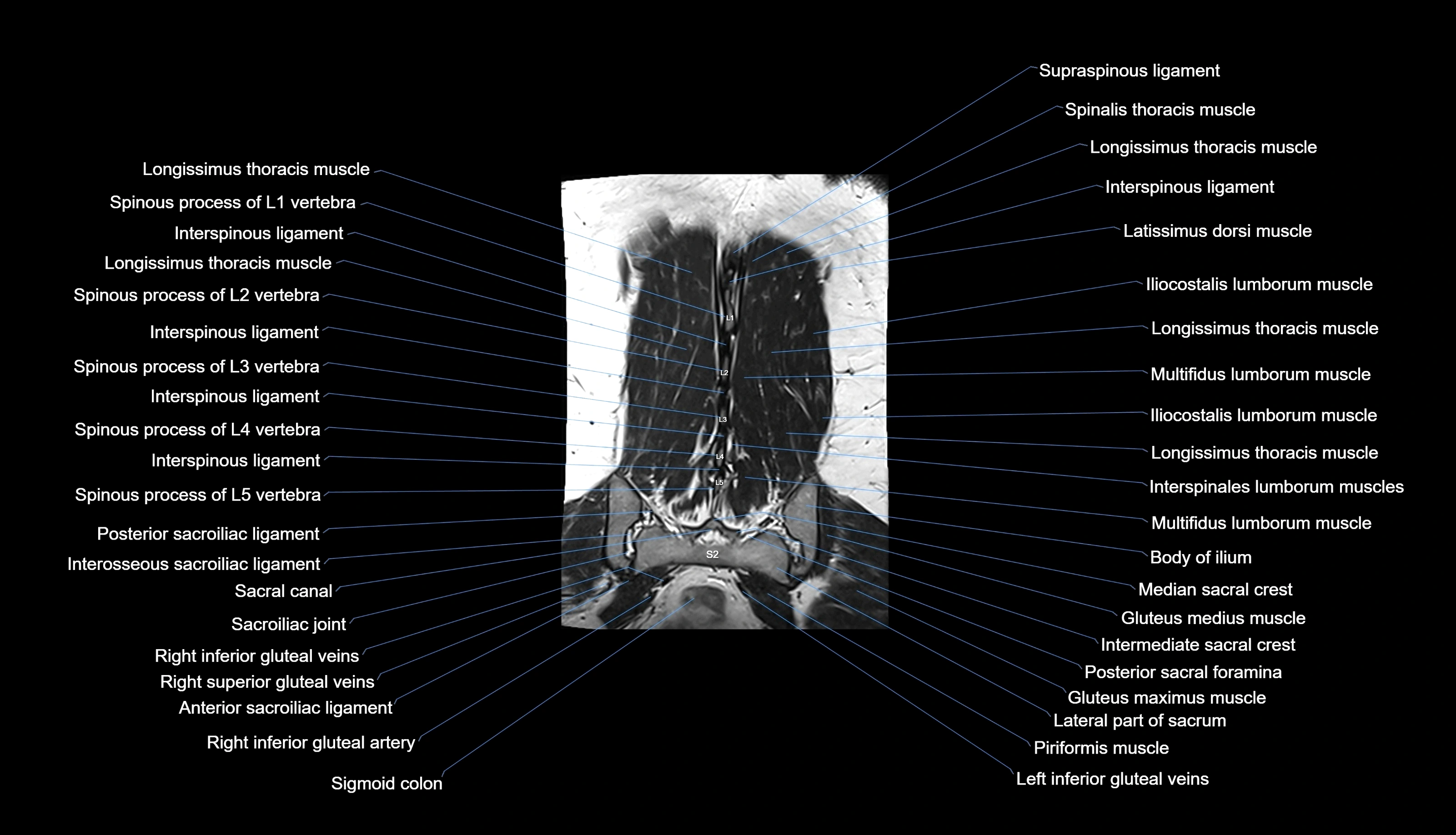 MRI lumbar spine labelled coronal cross sectional anatomy 3T radiology-img-00001-00033.webp